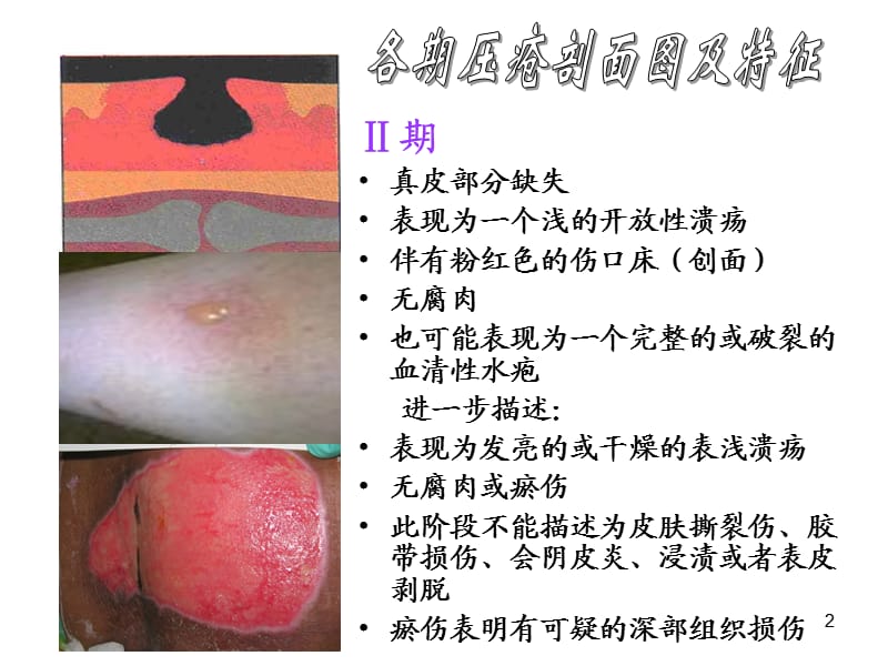 压疮分期图片及文字说明ppt课件_第2页