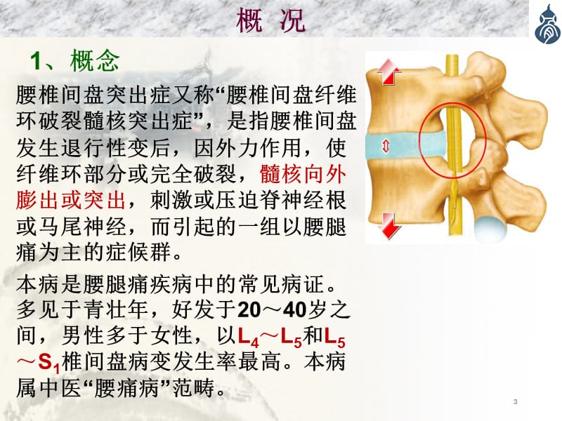 腰椎间盘突出症ppt课件_第3页