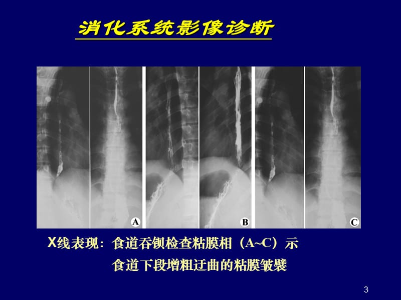 医学影像学消化系统常见疾病ppt课件_第3页