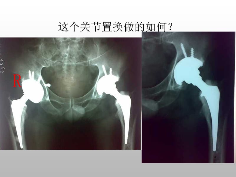 一文看懂全髋关节置换术后的X线评价ppt课件_第3页