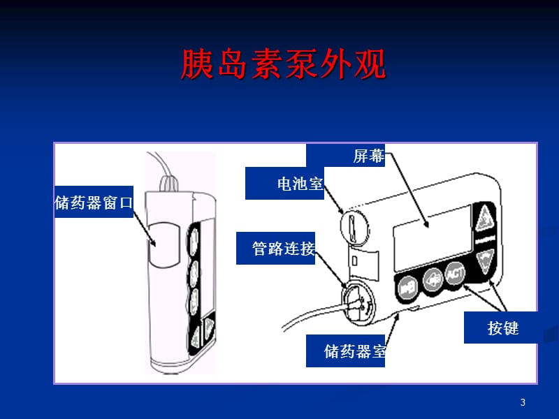 胰岛素泵治疗ppt课件_第3页