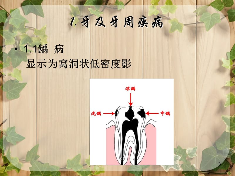 影像学牙牙周颌骨肿瘤样疾病ppt课件_第3页