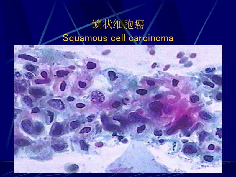 BS教学图库TBS-鳞状细胞癌.ppt_第3页