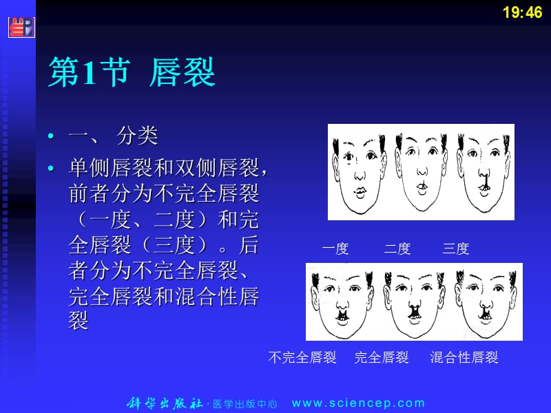 先天性唇裂与腭裂-高专高职《五官科学》(第二版).ppt_第3页