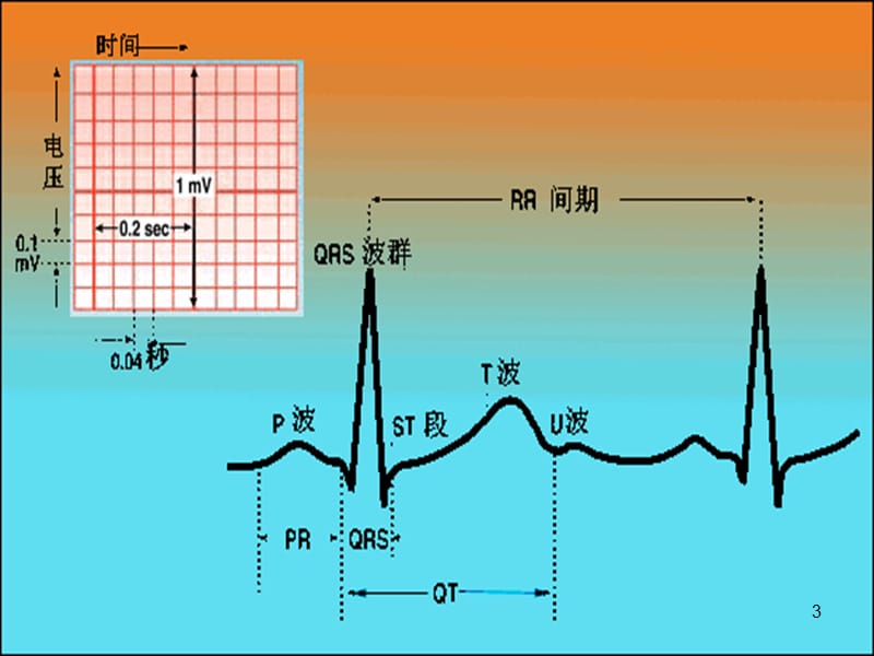 正常心电图及常见异常心电图的识别及处理ppt课件_第3页