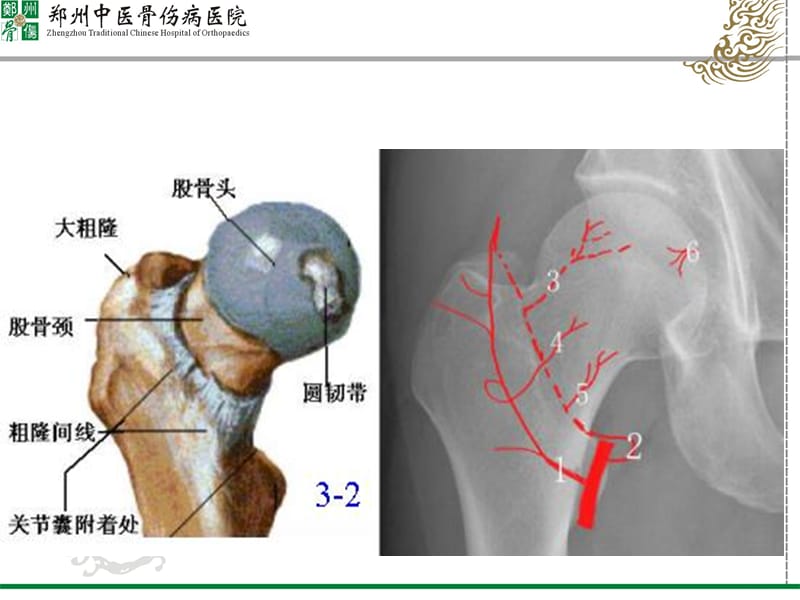 儿童股骨头坏死的诊断与治疗.ppt_第2页