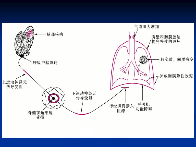 呼吸衰竭赵明-护理学.ppt_第3页