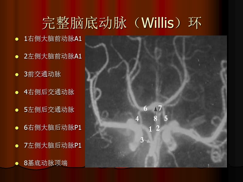 大脑前动脉动脉瘤用.ppt_第3页