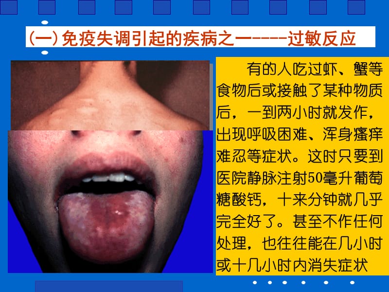 免疫失调引起的疾病.ppt_第3页