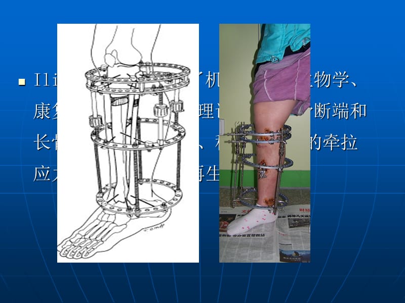 《肢体延长儿的护理》PPT课件.ppt_第2页