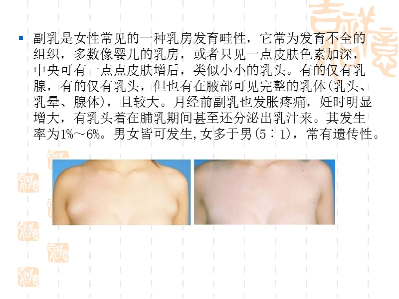 《副乳的治疗及护理》PPT课件.ppt_第3页