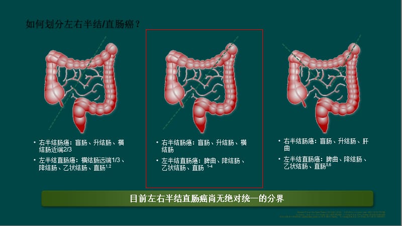 左右半结直肠癌的区别ppt课件_第3页