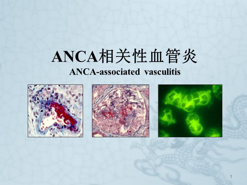 ANCA相关性血管炎ppt课件_第1页