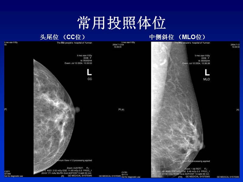 全数字化乳腺机的临床应用.ppt_第3页