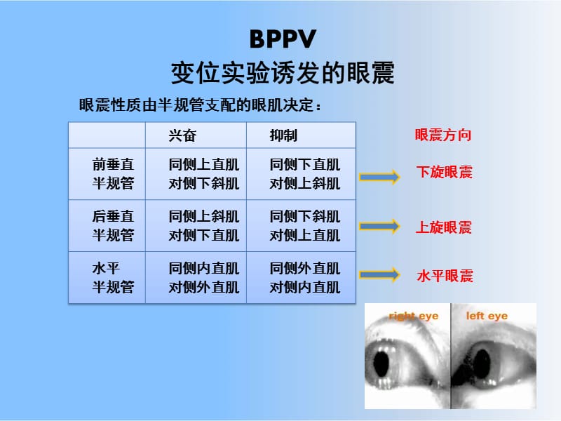 BPPV-CPPV良性位置性眩晕课件.ppt_第3页