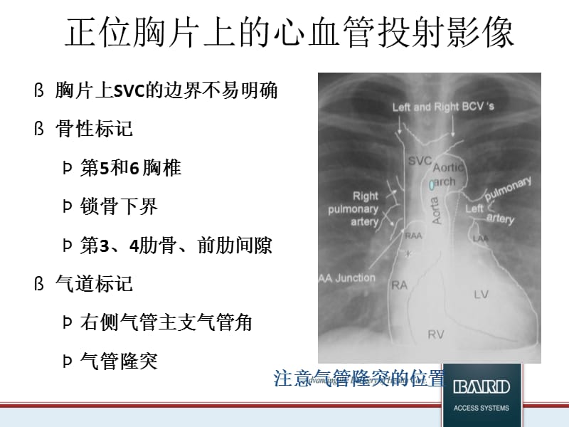 PICC尖端位置对于留置的影响.ppt_第3页