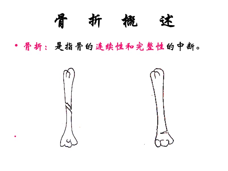 20-运动系统疾病病人的护理.ppt_第2页