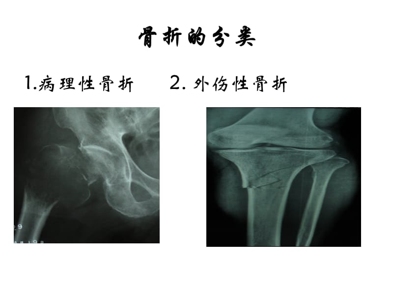 20-运动系统疾病病人的护理.ppt_第3页