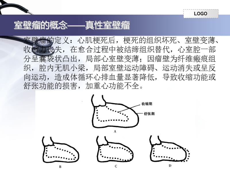 室壁瘤的诊治概略ppt课件_第2页