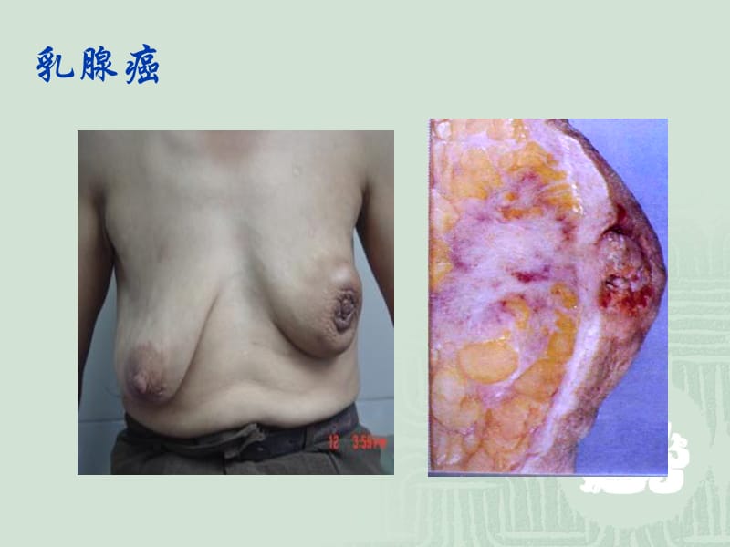 乳腺癌的发病机制、临床表现与病理学.ppt_第2页