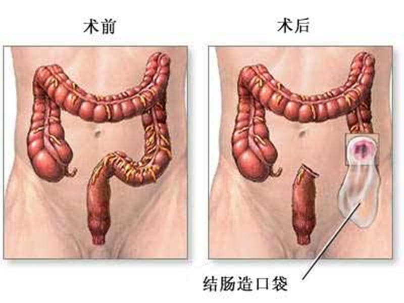 人工肛门的护理.ppt_第3页