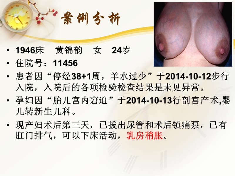 产后乳胀的护理.ppt_第2页