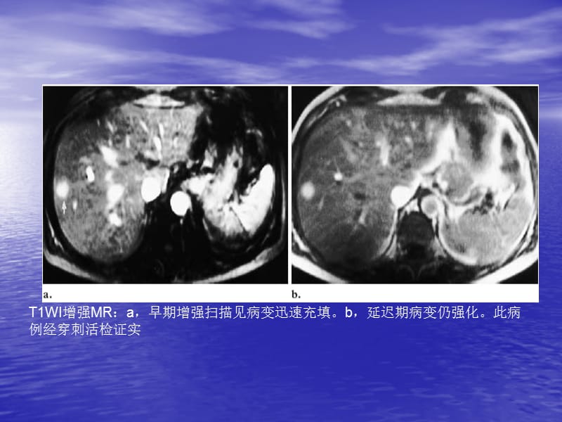 不典型肝血管瘤的影像学表现.ppt_第3页