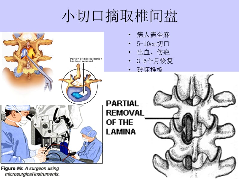 不同脊柱微创技术简介.ppt_第3页