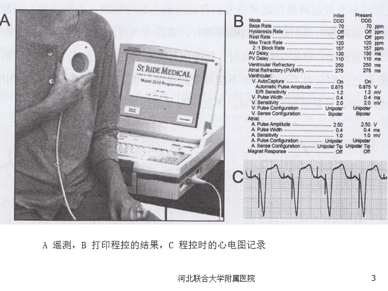 圣犹达起搏程控仪的使用及程控策略.ppt_第3页