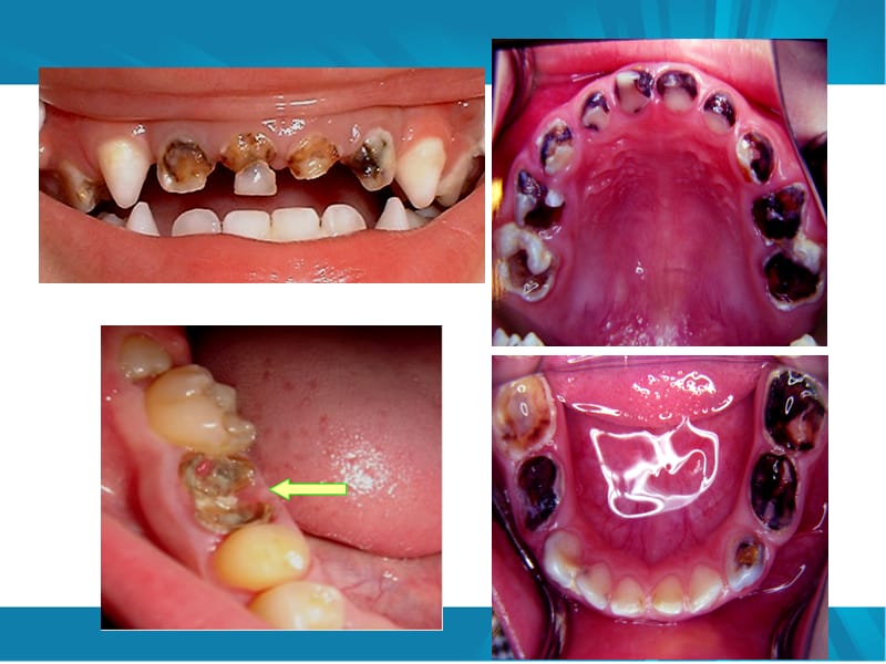 儿童口腔保健及不良习惯.ppt_第3页