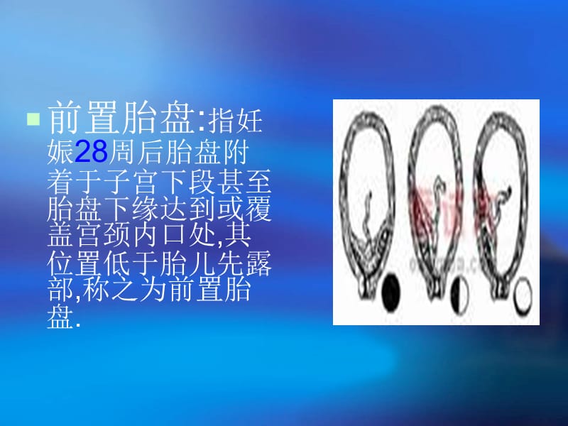 前置胎盘与胎盘早剥的区别.ppt_第3页