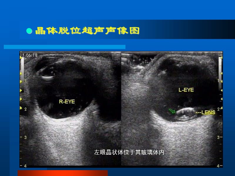 眼部常见病的超声诊断第二部分.ppt_第3页