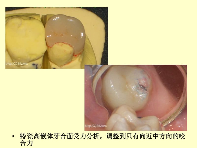 口腔修复病例讨论.ppt_第3页