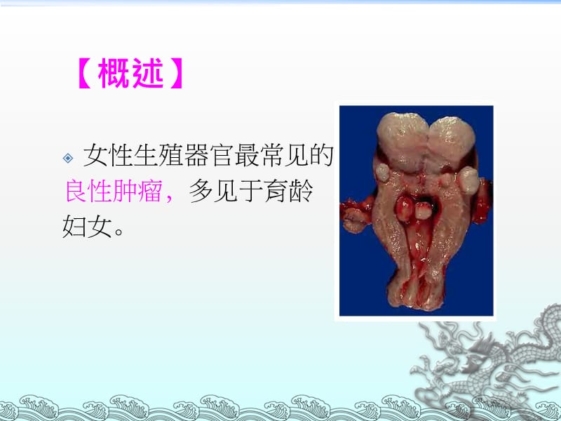 子宫肌瘤病人的术后护理.ppt_第3页