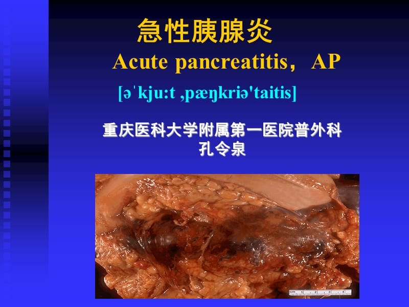 急性胰腺炎优秀课件.ppt_第1页