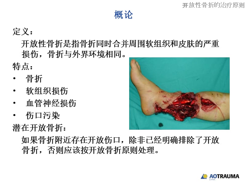 开放性骨折的治疗原则.ppt_第3页