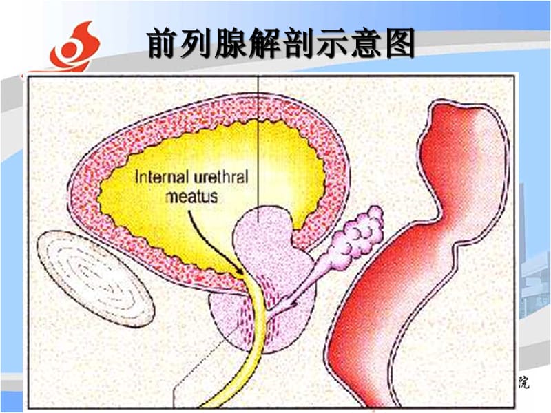 前列腺电切术后并发症的防治.ppt_第2页