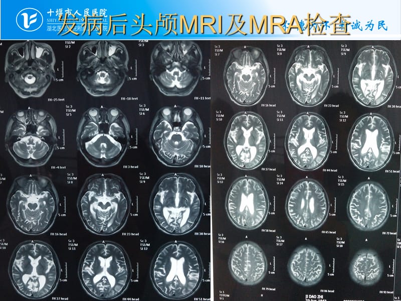 脑梗死出血性转化.ppt_第3页