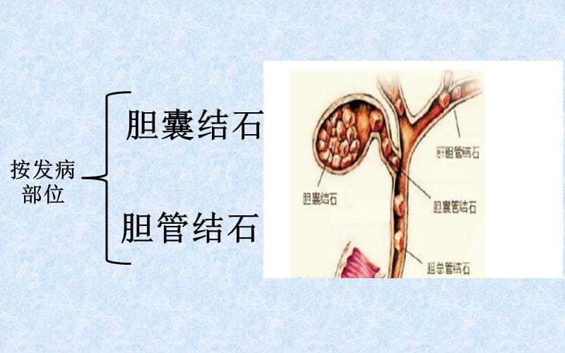 胆结石健康教育完善版.ppt_第3页