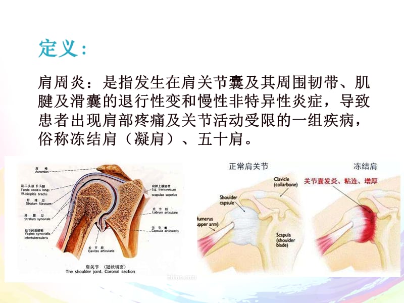 肩周炎的治疗及护理.ppt_第2页