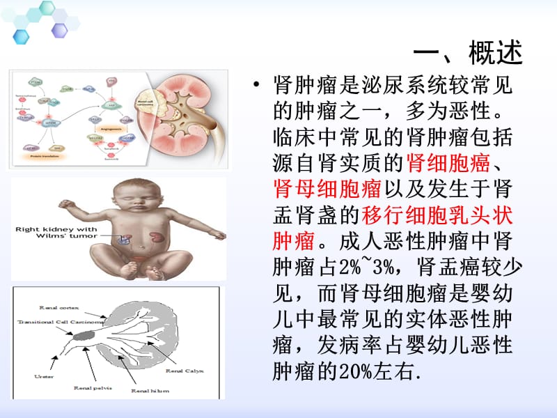 肾癌(护理查房).ppt_第2页