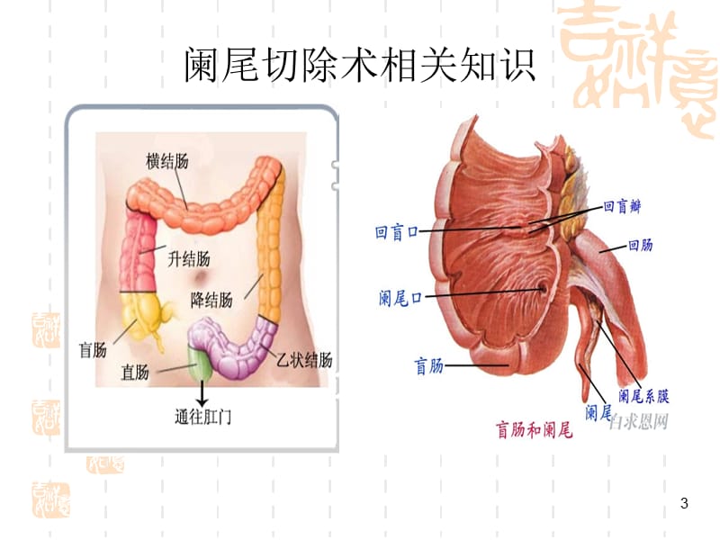 阑尾切除术相关知识及手术步骤.ppt_第3页