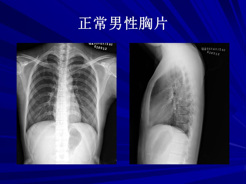 胸部X线基础读片.ppt_第2页