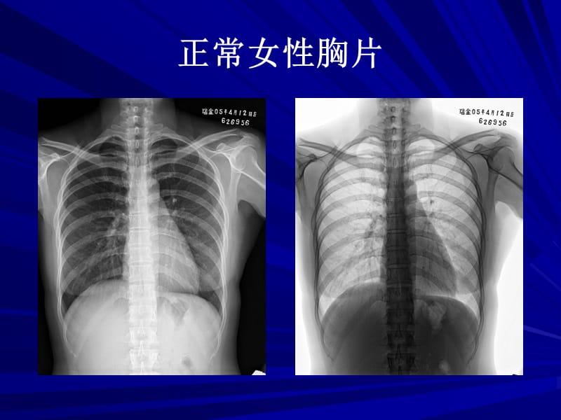 胸部X线基础读片.ppt_第3页