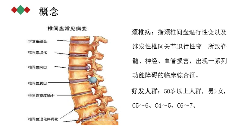 颈椎病的护理查房.ppt_第2页