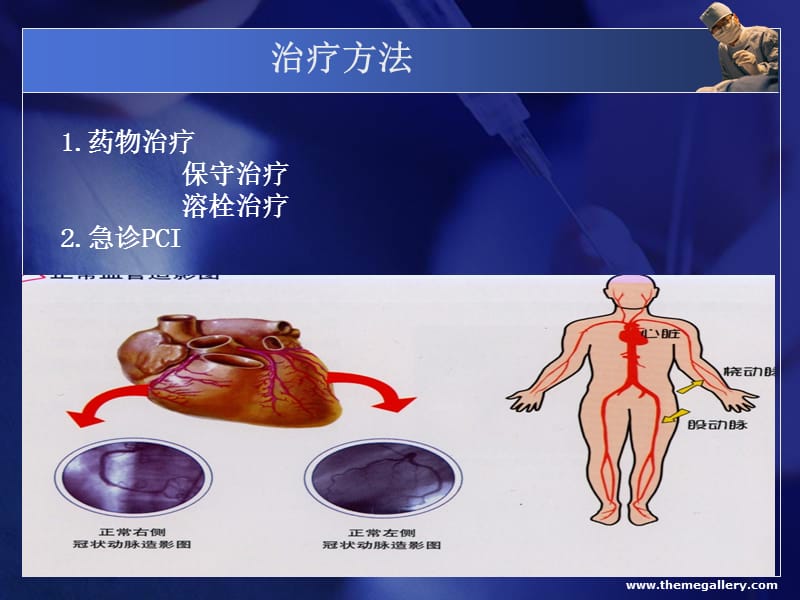 《PCI术后护理》PPT课件.ppt_第3页