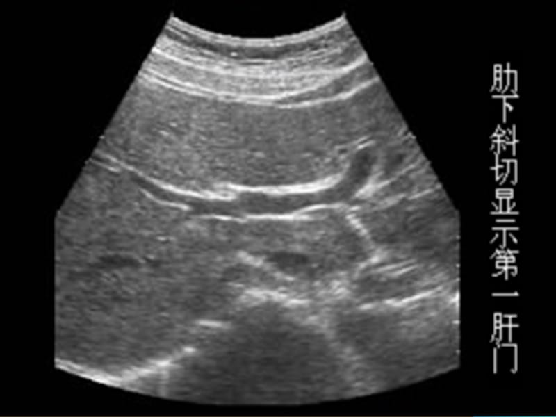 肝脏的8个标准切面声像图示范.ppt_第2页
