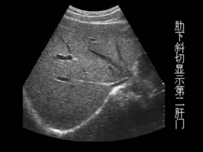 肝脏的8个标准切面声像图示范.ppt_第3页