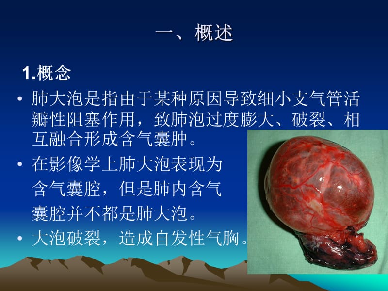 肺大泡(影像学诊断及鉴别诊断).ppt_第2页