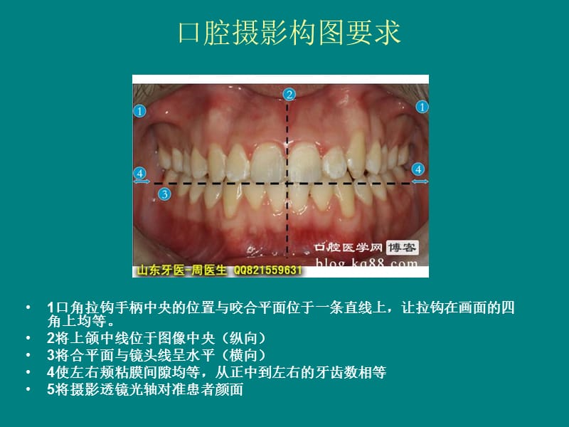 跟我学口腔摄影-拍摄美国正畸协会(ABO)口内像.ppt_第2页